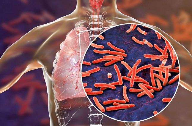 ¿Qué es la tuberculosis, una enfermedad crónica y hasta mortífera?