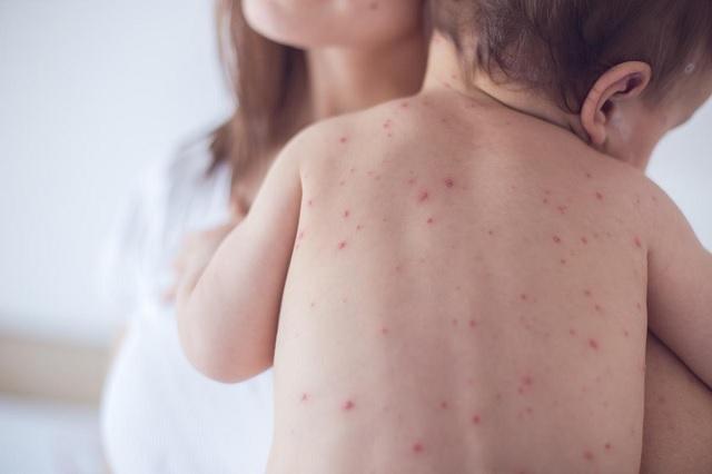 Casos de varicela en México se duplican en un año