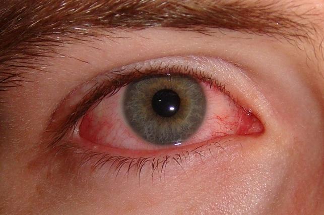 5 remedios caseros para aliviar la conjuntivitis u ojo rojo