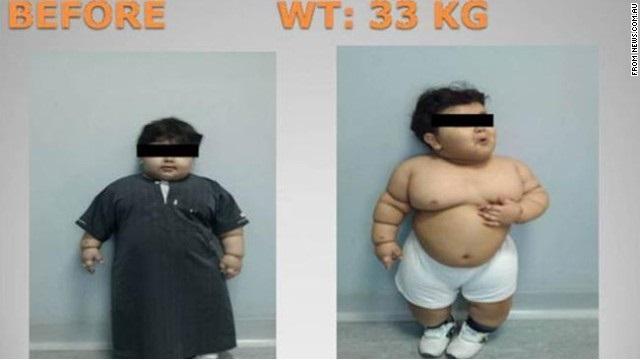 Por obesidad, un niño es sometido a una cirugía a los 2 años de edad